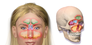 Sinuzita, boala sinusurilor Sinuzita, boala sinusurilor