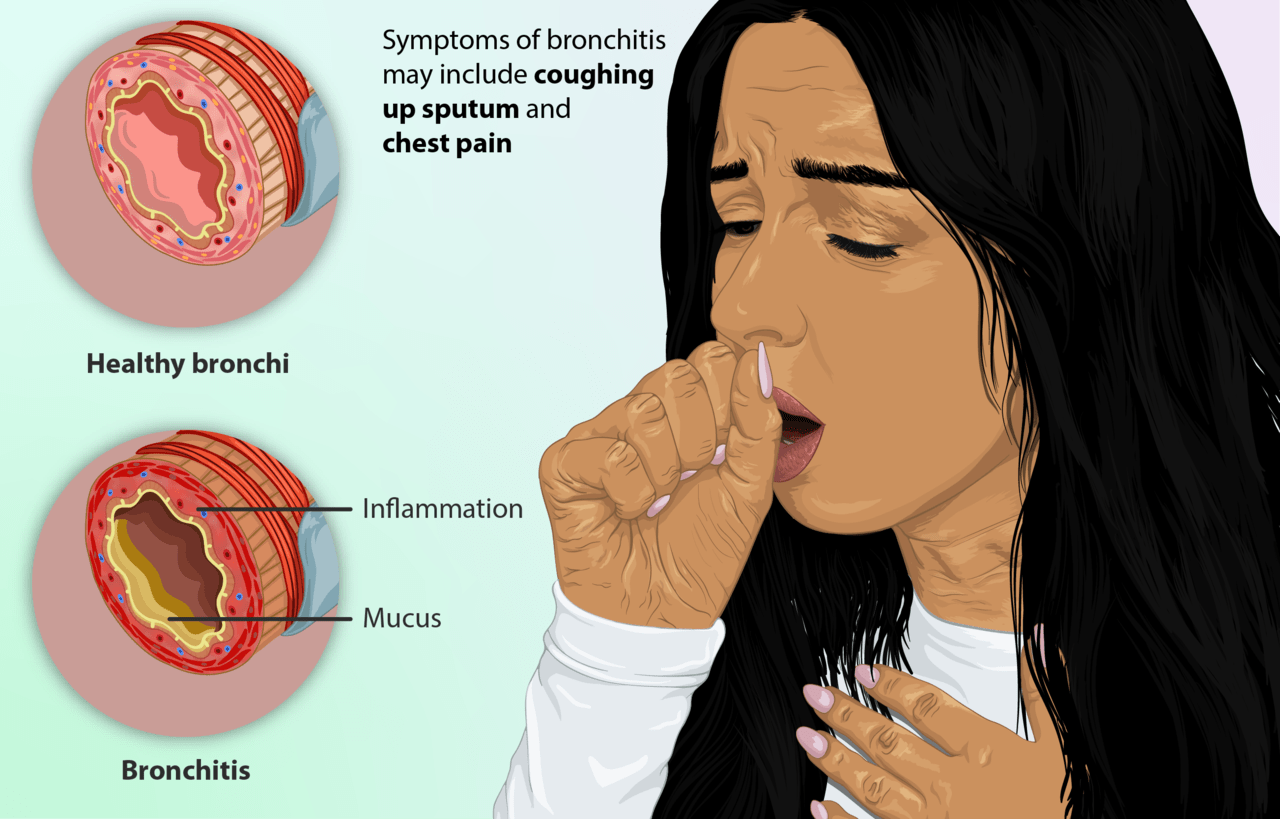 persoana care sufera de bronsita