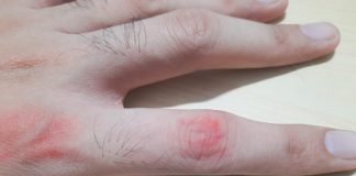 Amortelile si furnicaturile