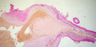 Anevrismul la nivelul creierului Anevrismul la nivelul creierului