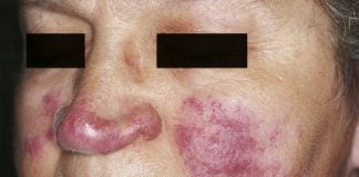 Boala Lupus - cand organismul lupta impotriva noastra