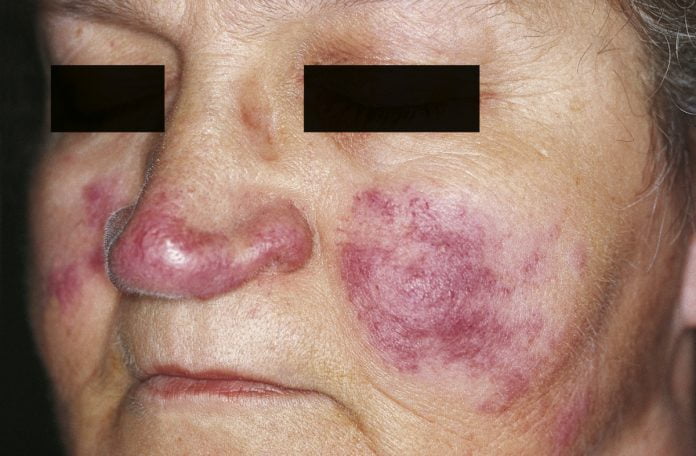 Boala Lupus - cand organismul lupta impotriva noastra Boala Lupus - cand organismul lupta impotriva noastra