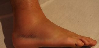 Ce sunt entorsele si care sunt etapele primului ajutor? Ce sunt entorsele si care sunt etapele primului ajutor