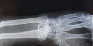 Ce trebuie sa stim despre refacerea oaselor