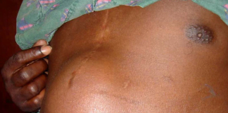 Herniile clasificari, cauze si tratamente