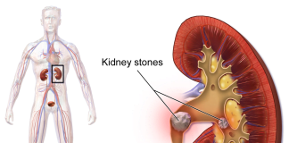Infectii ale rinichilor