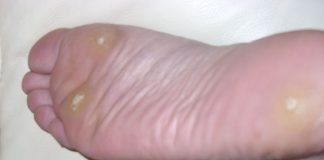 Metode de eliminare a negilor