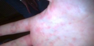 Mononucleoza infectioasa