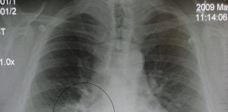 Pneumonia