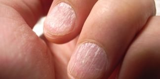 Probleme cu unghiile Probleme cu unghiile