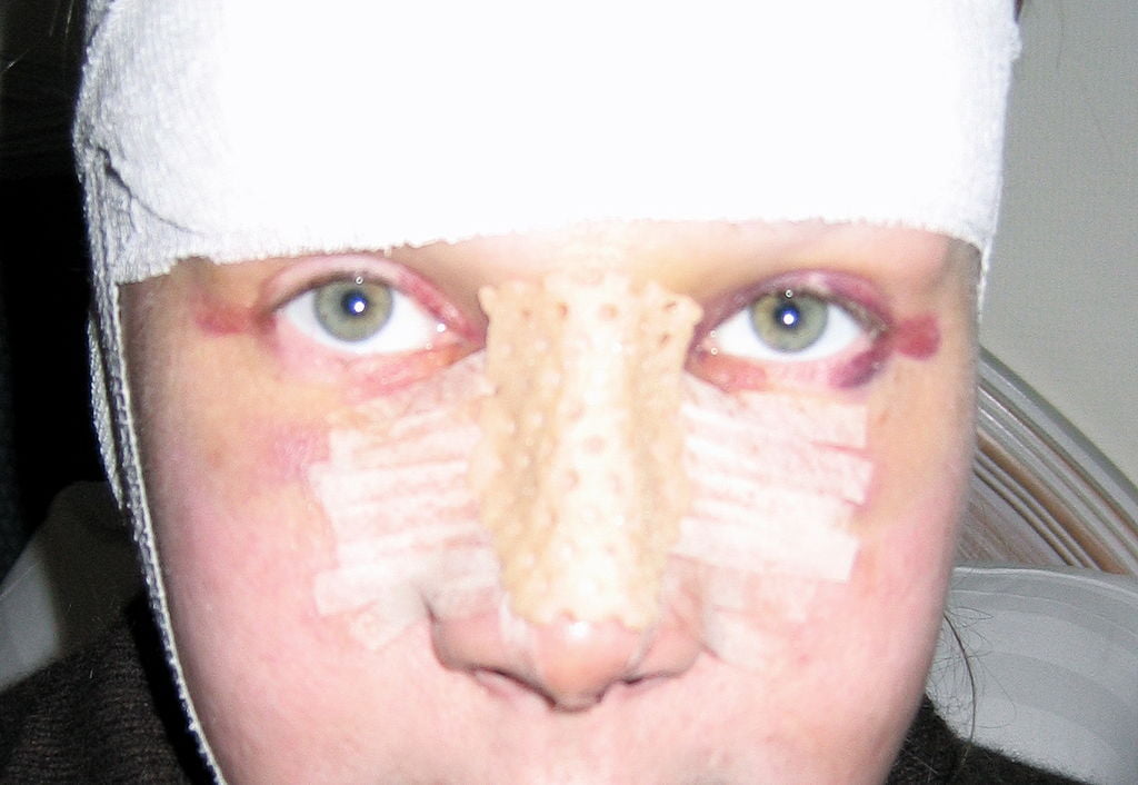 Rinoplastia