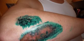 Scabia cum se transmite, cum se manifesta si ce tratamente puteti face