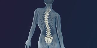 Scolioza, o curbura laterala anormala a coloanei vertebrale