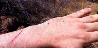 Taieturi si zgarieturi - Metode de tratament