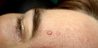 Tenul seboreic – caracteristici si metode de tratament Tenul seboreic - caracteristici si metode de tratament