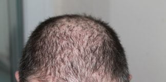 Tratamente pentru caderea parului