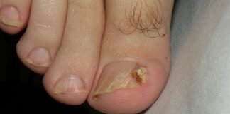 Vezi de ce apare si cum tratezi unghia incarnata fara sa o indepartezi