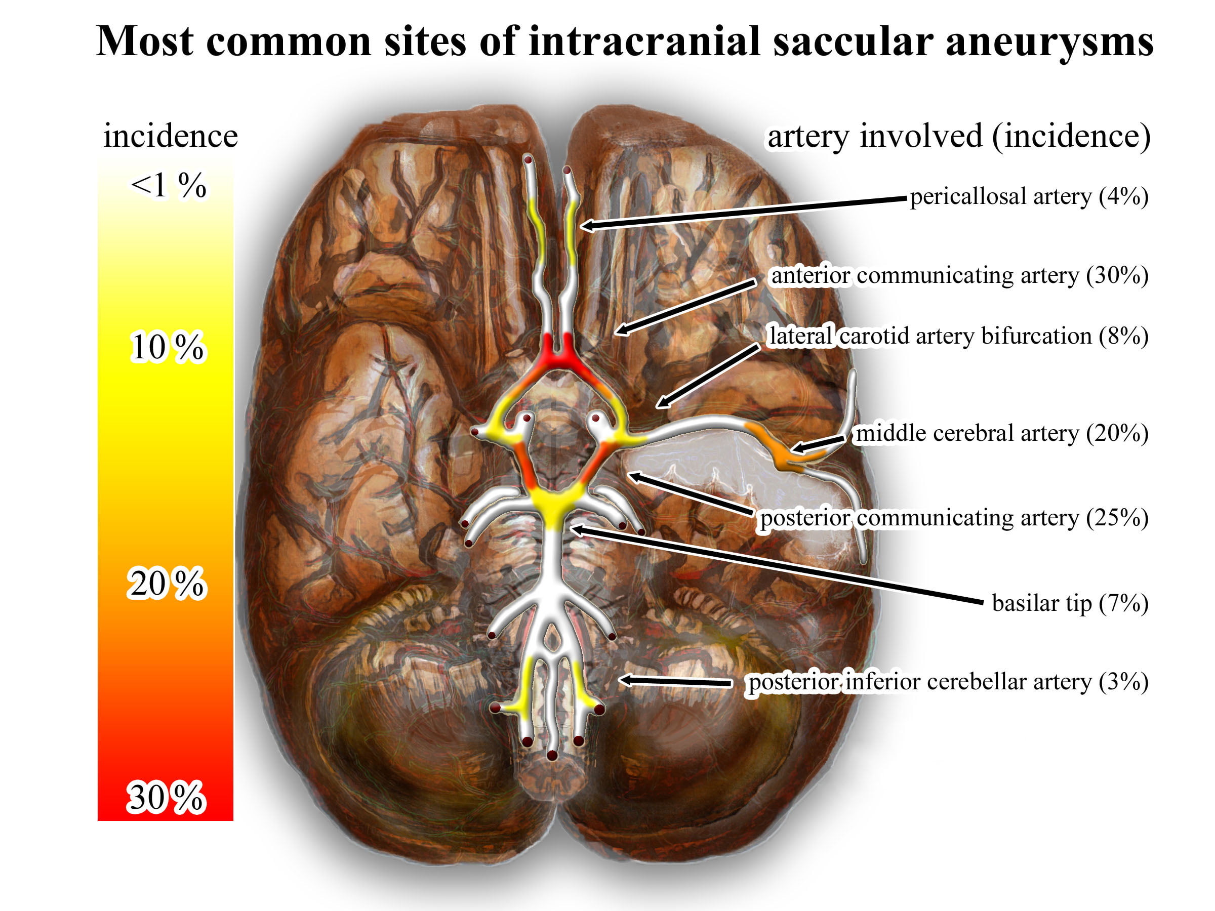 avevrism cerebral