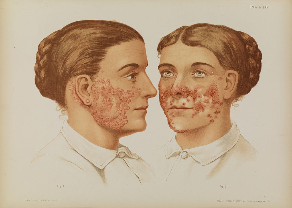 boala Lupus