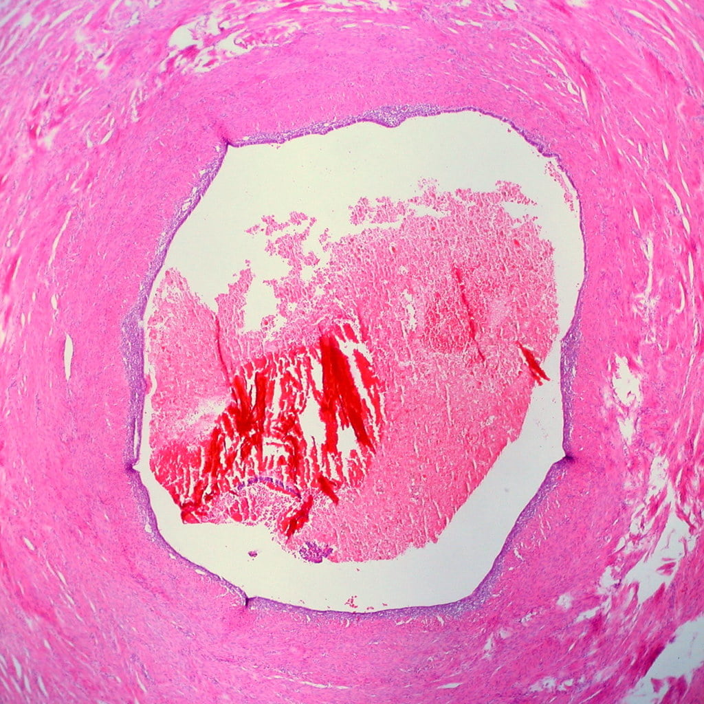 endrometrioza