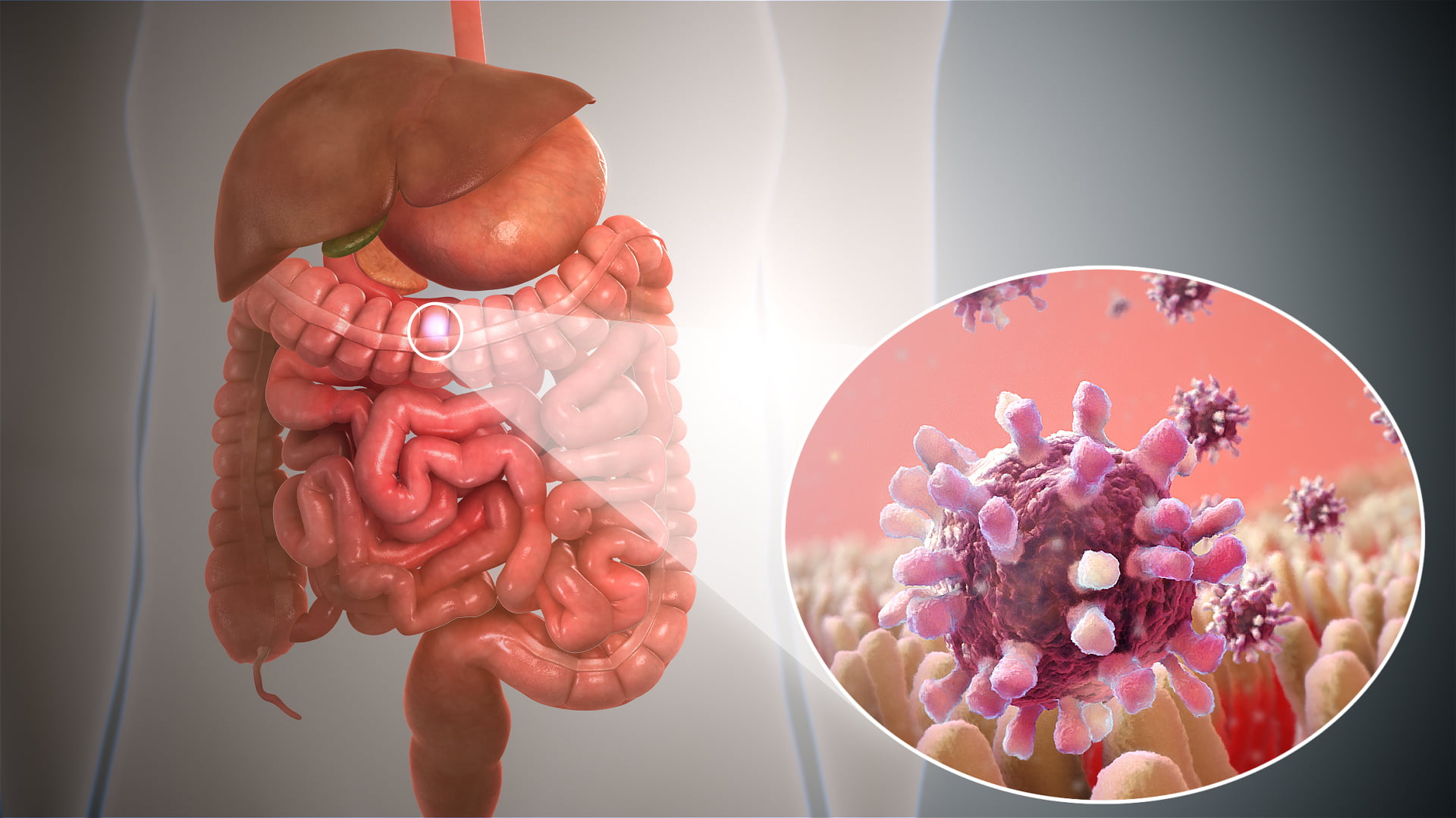 gastroenterita