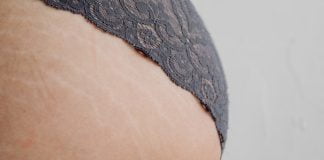 Remedii eficiente pentru tratarea vergeturilor