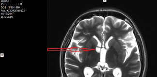 Afla in ce consta cancerul cerebral de la nivelul tesutului cerebral si care sunt metodele de tratament Afla in ce consta cancerul cerebral de la nivelul tesutului cerebral si care sunt metodele de tratament