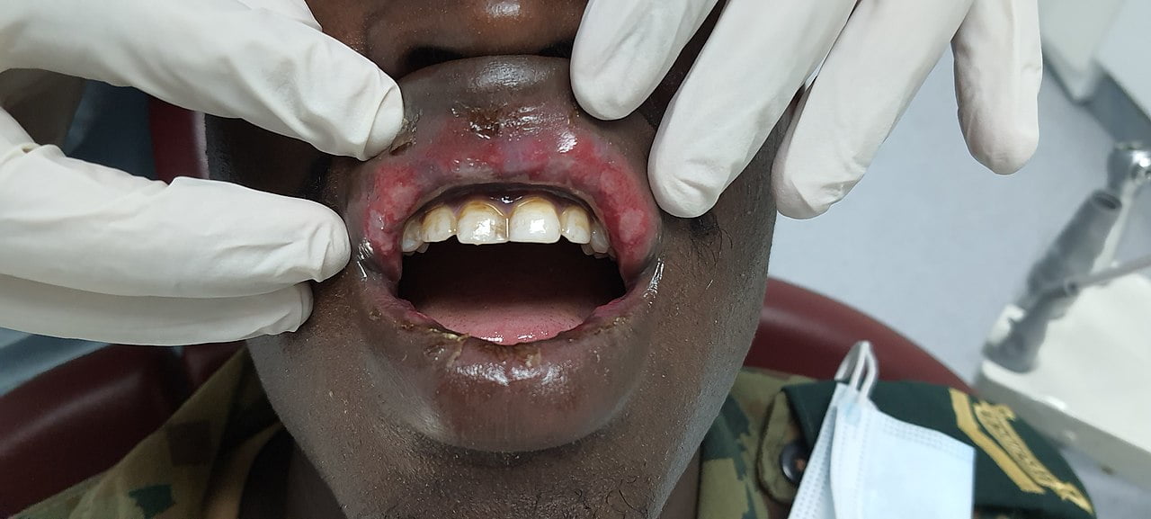 Cancerul cavitatii bucale