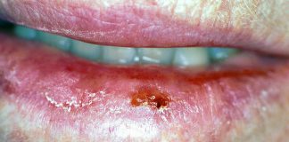 Cancerul cavitatii bucale – Metode de tratament Cancerul cavitatii bucale - Metode de tratament