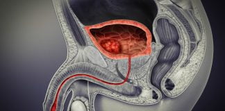 Cancerul vezicii urinare Cancerul vezicii urinare