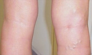 inflamația venelor venelor de pe picioare cum să tratați propolisul varicoză