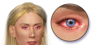 Tratamente naturiste pentru conjunctivita Tratamente naturiste pentru conjunctivita