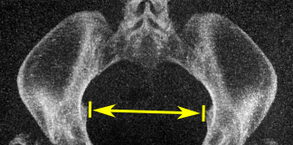 Boala inflamatorie pelviana – Simptome, cauze si tratament Boala inflamatorie pelviana - Simptome, cauze si tratament