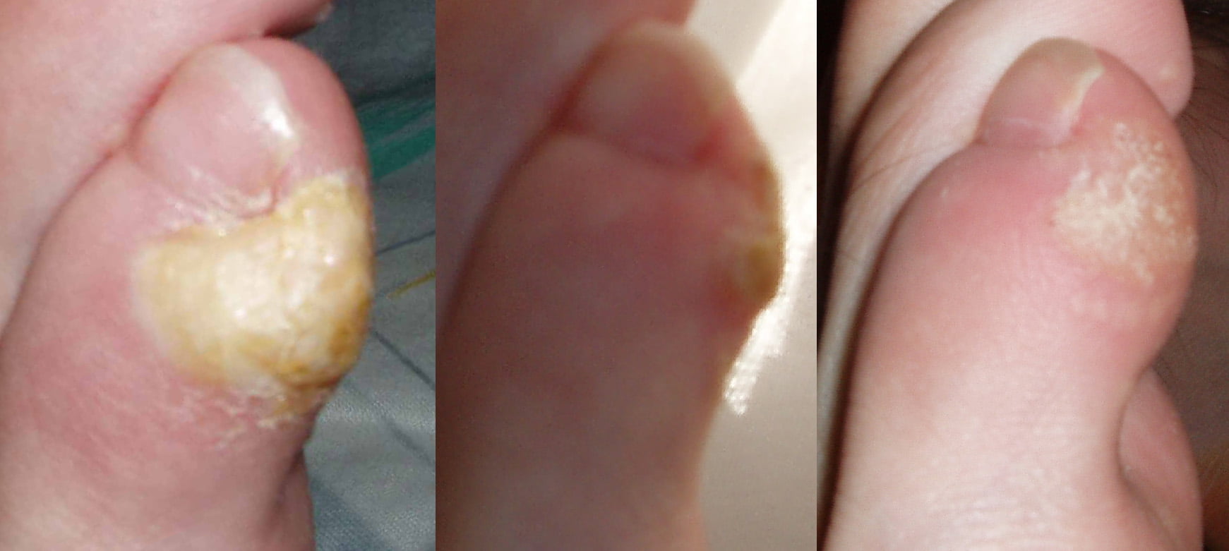 simple remedii pentru indepartarea bataturilor