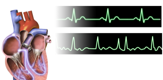 Aritmia inimii – Metode de tratament Aritmia inimii - Metode de tratament