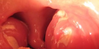 Boala sarutului – Mononucleoza Boala sarutului - Mononucleoza