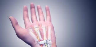 Sindromul de canal carpian – Simptome, cauze si tratament Sindromul de canal carpian - Simptome, cauze si tratament