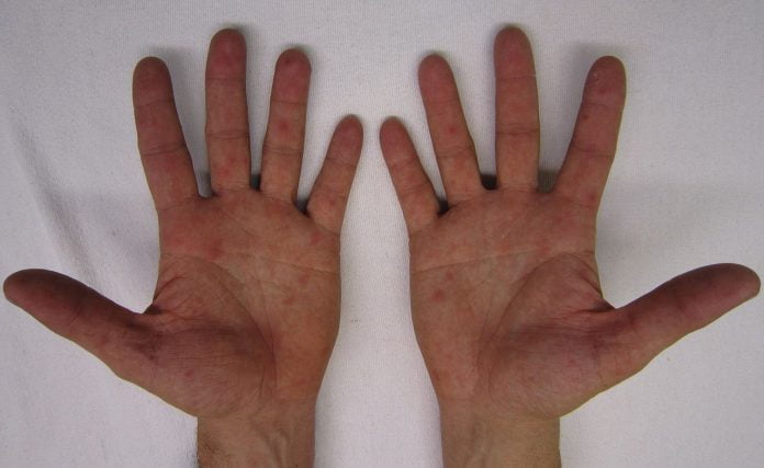Sindromul socului toxic - Simptome si tratament Sindromul socului toxic - Simptome si tratament
