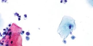 Tricomonaza, o infectie transmisa prin contact sexual Tricomonaza, o infectie transmisa prin contact sexual