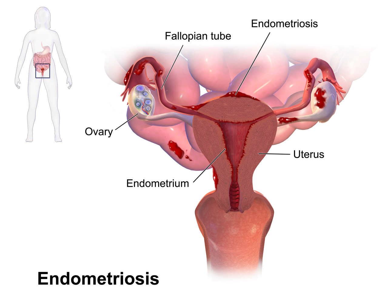 endometrioza