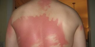 Arsurile solare - cauze, simptome si remedii naturale