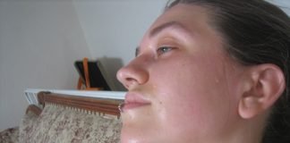 Insolatia si alte probleme datorate caldurii