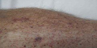 Melanomul, un cancer teribil de piele Melanomul, un cancer teribil de piele