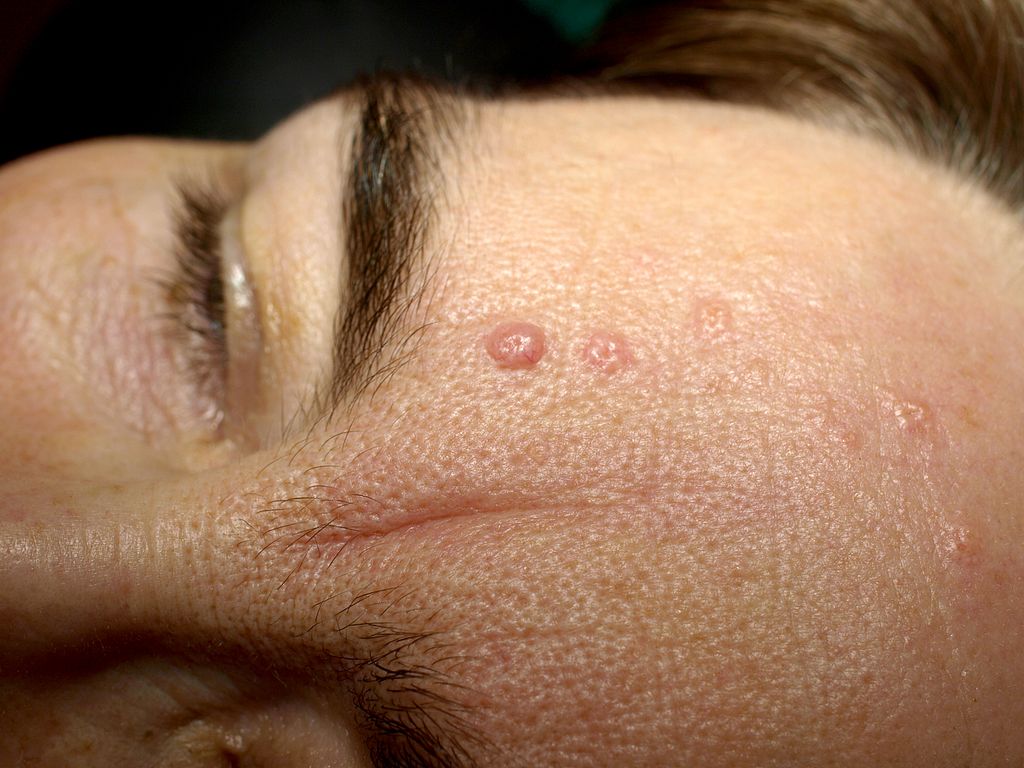 dermatita