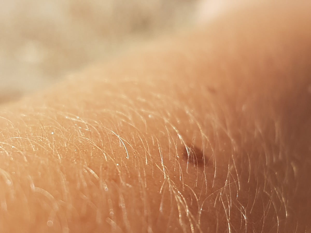 melanoma