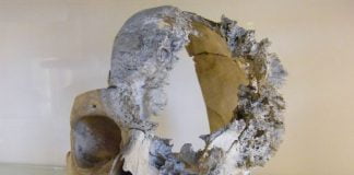 Cancerul osos - cauze, simptome, tratament