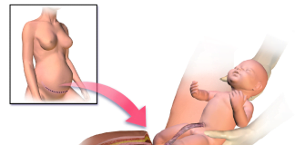 Operatia cezariana - argumente pro si contra