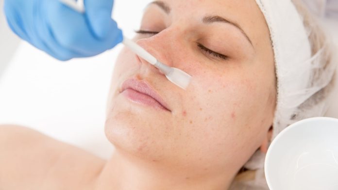 Peeling chimic pentru fata Peeling chimic pentru fata