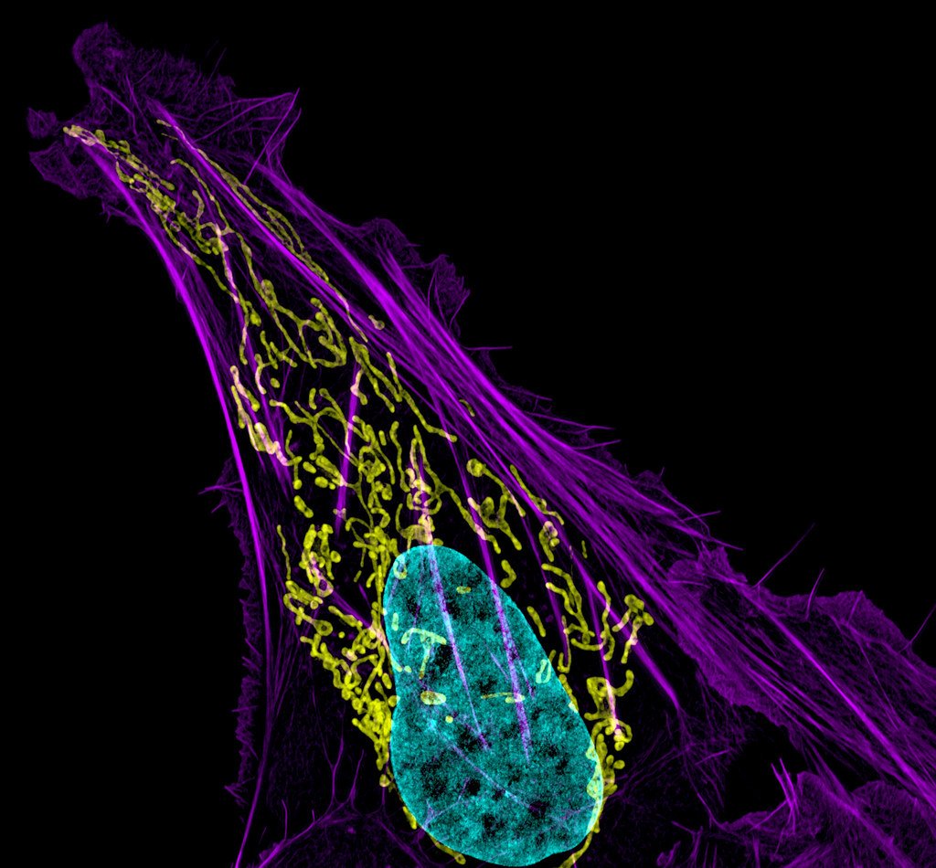 celula canceroasa