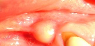 Abcesul dentar - Simptome, tratament si prevenire